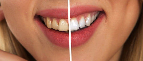 Bande blanchiment dentaire